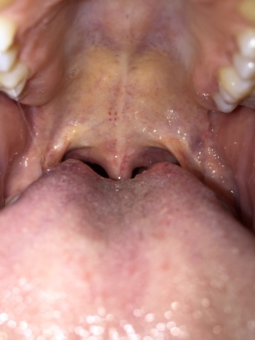 Is A Yellow Soft Palate Normal